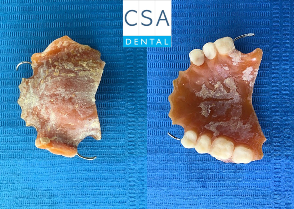 Prótesis dental sin higienizar